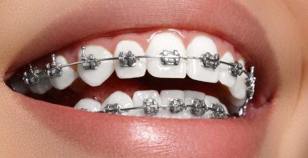 What to Do if a Bracket Detaches During Orthodontic Treatment