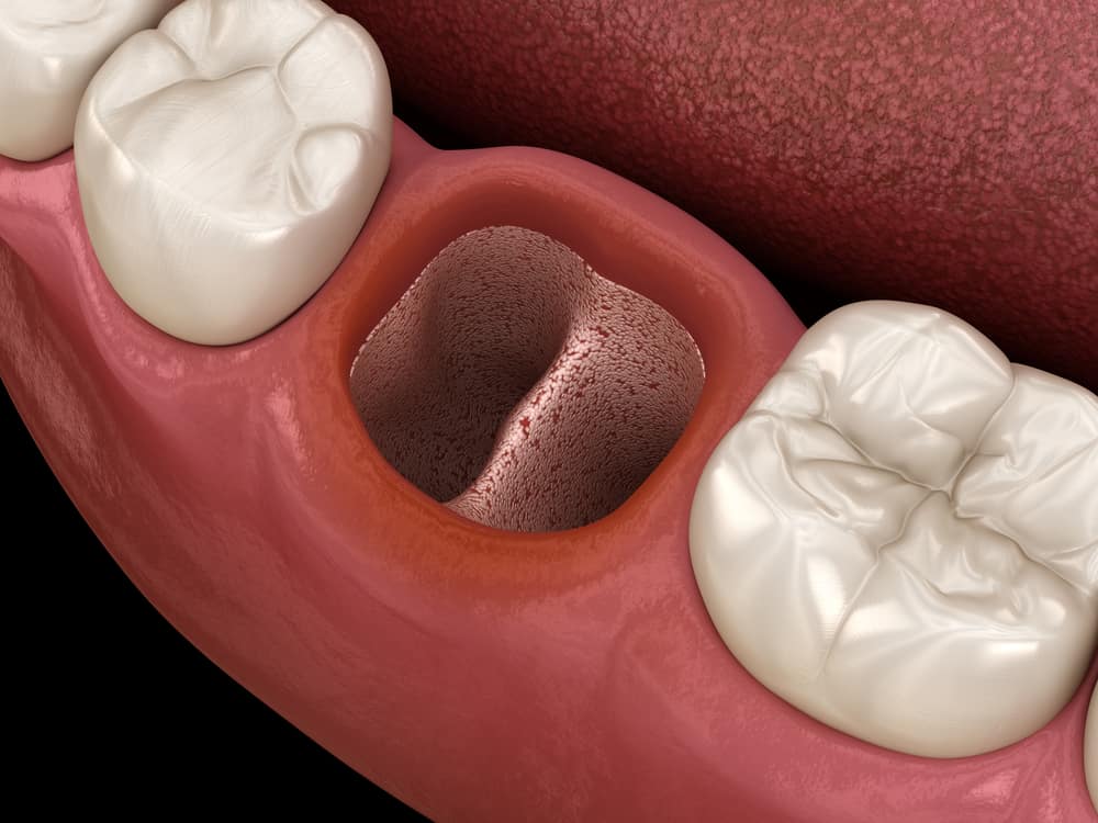 What is Dry Socket in Dentistry?