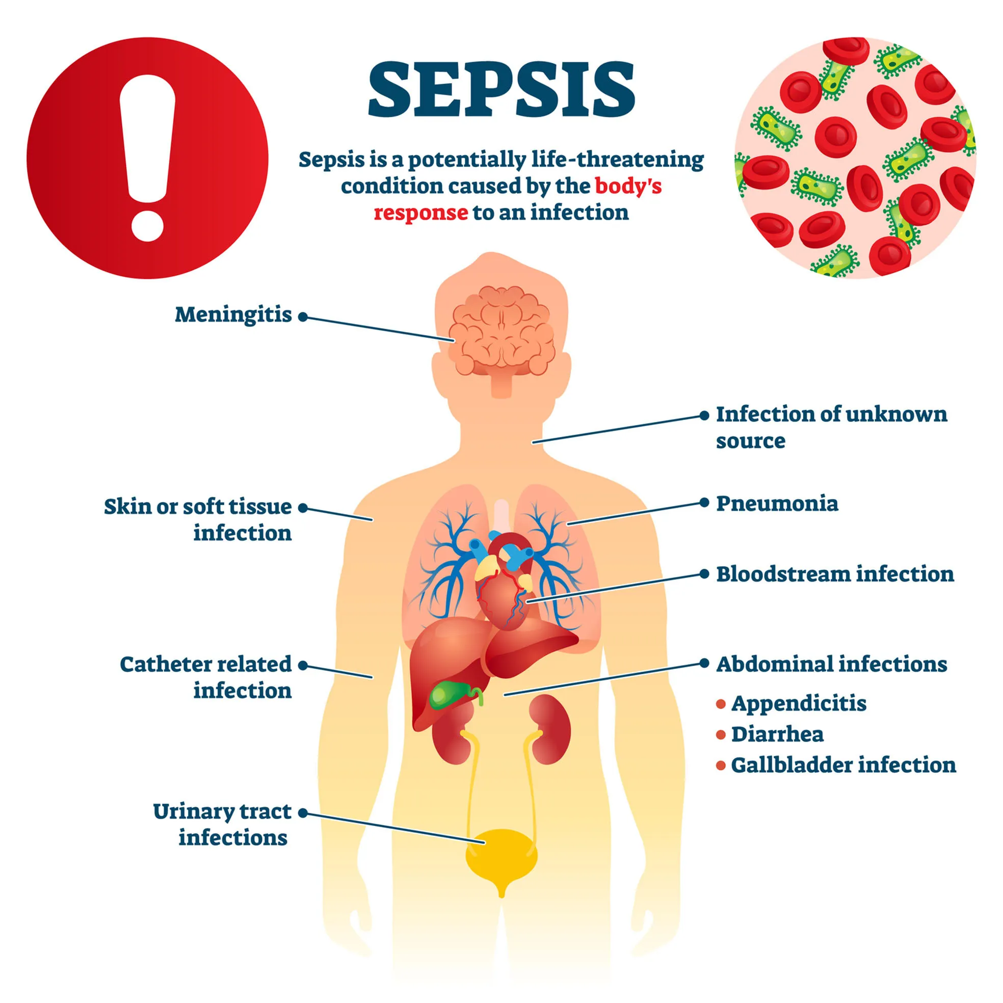 What Is Sepsis?