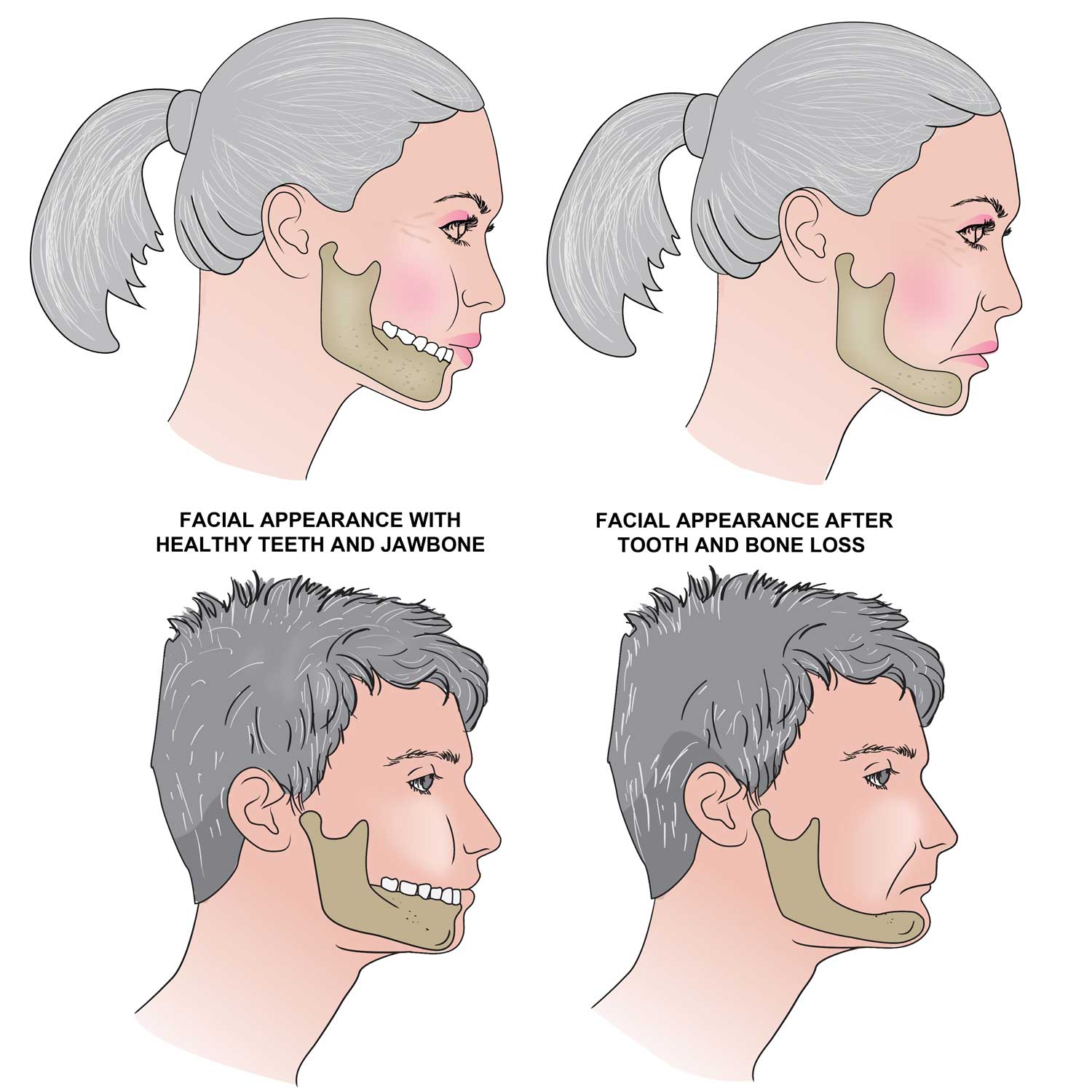 How Missing Teeth Affect Your Face Shape and Jawline