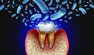 Sepsis from Tooth Decay and Gum Disease