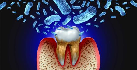 Sepsis from Tooth Decay and Gum Disease